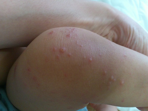 手足口病にはいくつか種類があり、症状の重さも個人差があるそうです