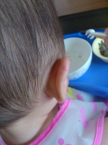 耳にまで出た湿疹