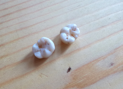 奥歯も抜けました。